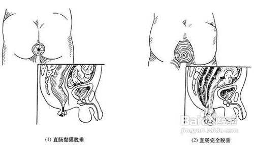 直肠脱垂会出现什么症状