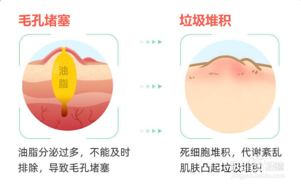 鼻头上的粉刺怎样根除