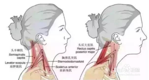 颈椎病引起的头痛怎么缓解?