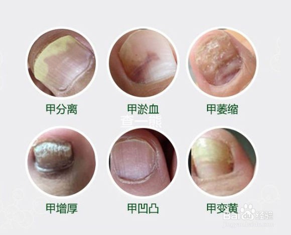 孙叔公灰指甲治疗手册