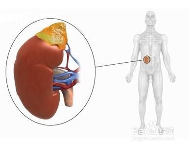 肾病综合征的四个并发症您知道吗