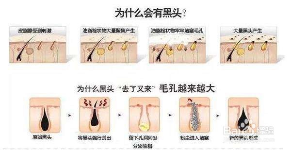 鼻子上的黑头怎么去掉·先知先得