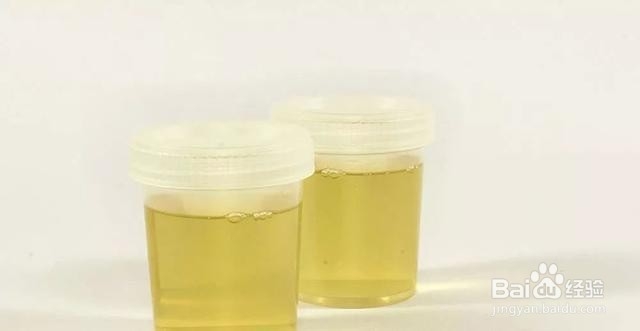 一喝水就内急和喝水不上厕所的人,哪个更健康?