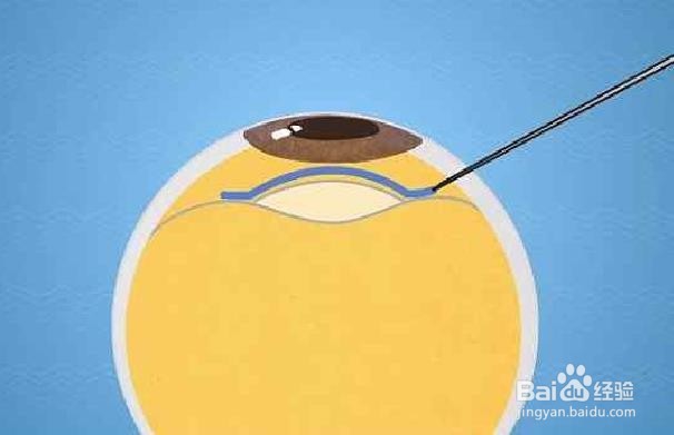 需要矫正视力的五个标志