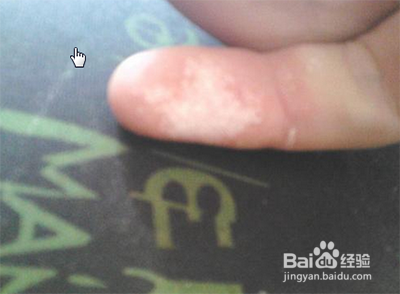 双氧水把手烧白了怎么办