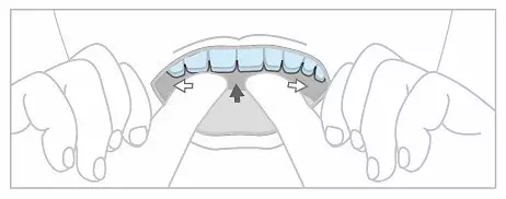 南宁隐形矫治器正确的摘戴方法