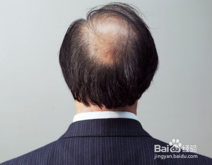 如何防止脂溢性脱发