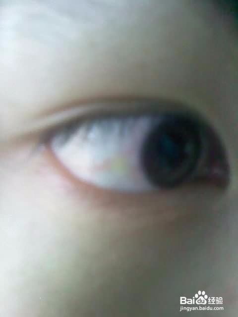 肾脏的先兆表现有哪些二