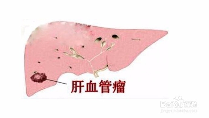 脂肪肝及常见的肝病预防