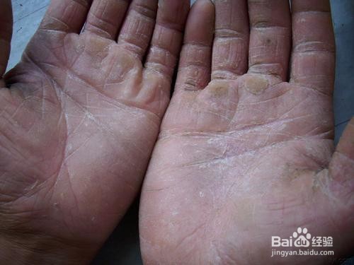 手脚容易裂口有什么办法能解决?