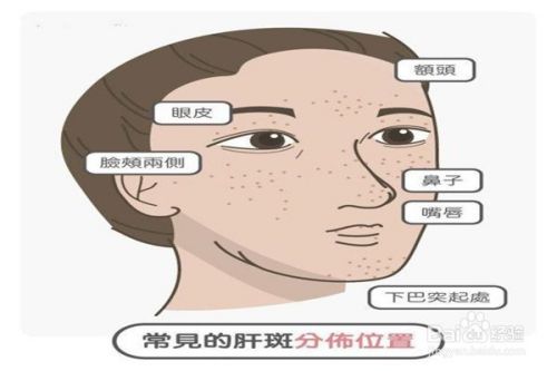 怎样去掉脸上的肝斑 百度经验