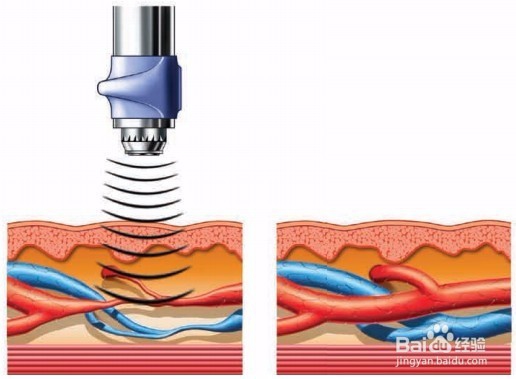 冲击波疼痛治疗仪的简介和使用方法
