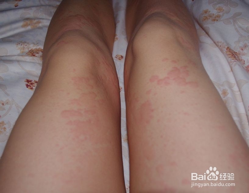 患了荨麻疹应注意哪些问题？