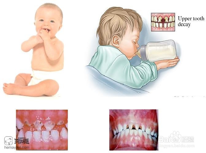 儿童蛀牙奶瓶龋怎么办?