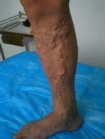 久坐的危害有哪些？