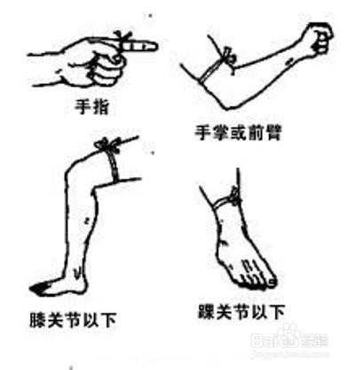 在野外被蛇咬伤怎么办？