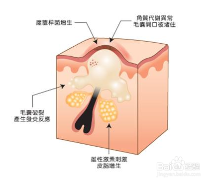 痤疮的形成原因是什么？有哪些去痘的有效方法？