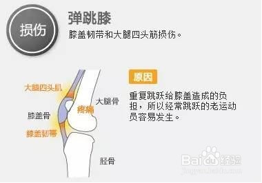 【运动课堂一】膝盖的损伤和预防