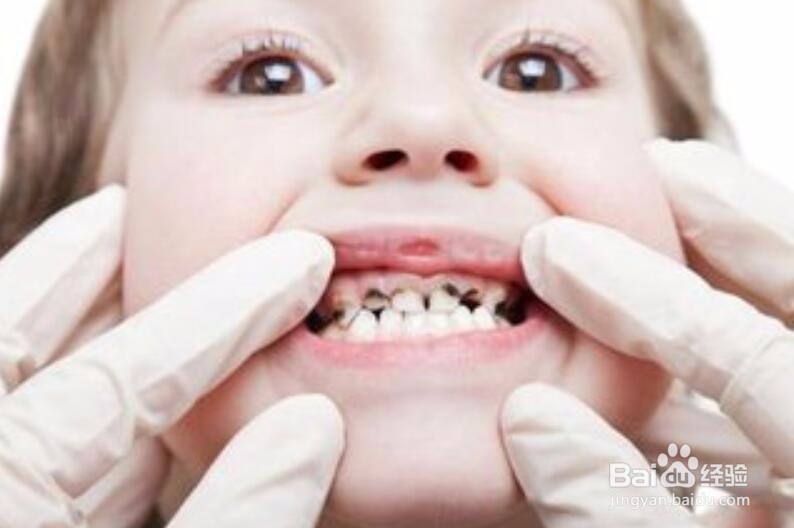 孩子换牙时该注意些什么？