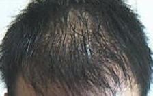 脱发的具体原因