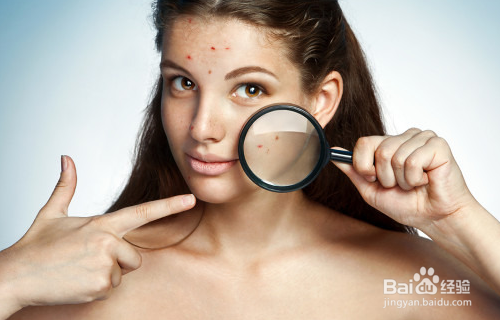 闭口粉刺如何快速消掉