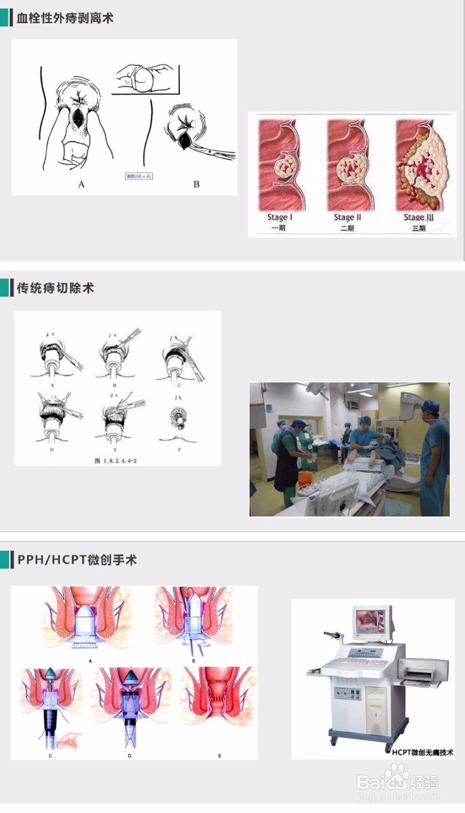 外剥内扎术动画演示图片