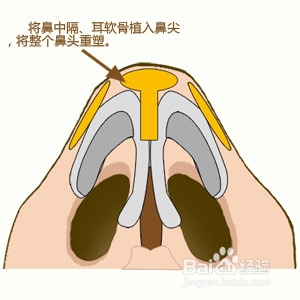 特异鼻综合整形