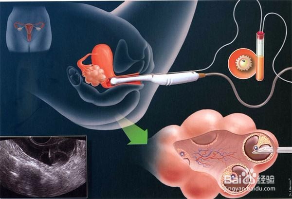 染色体易位如何要孩子