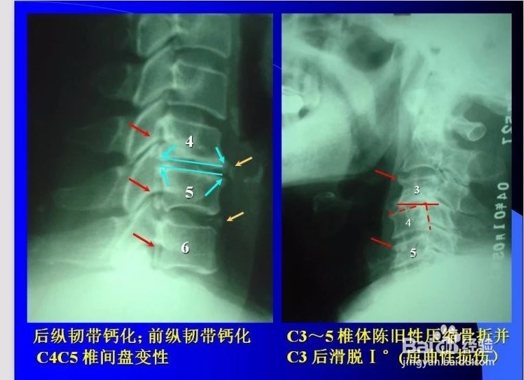 脊椎病的诊断与观片方法