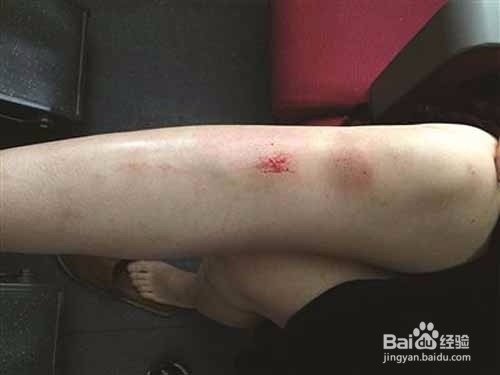 小腿上黑斑怎么去除