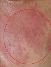 患上皮炎怎么办