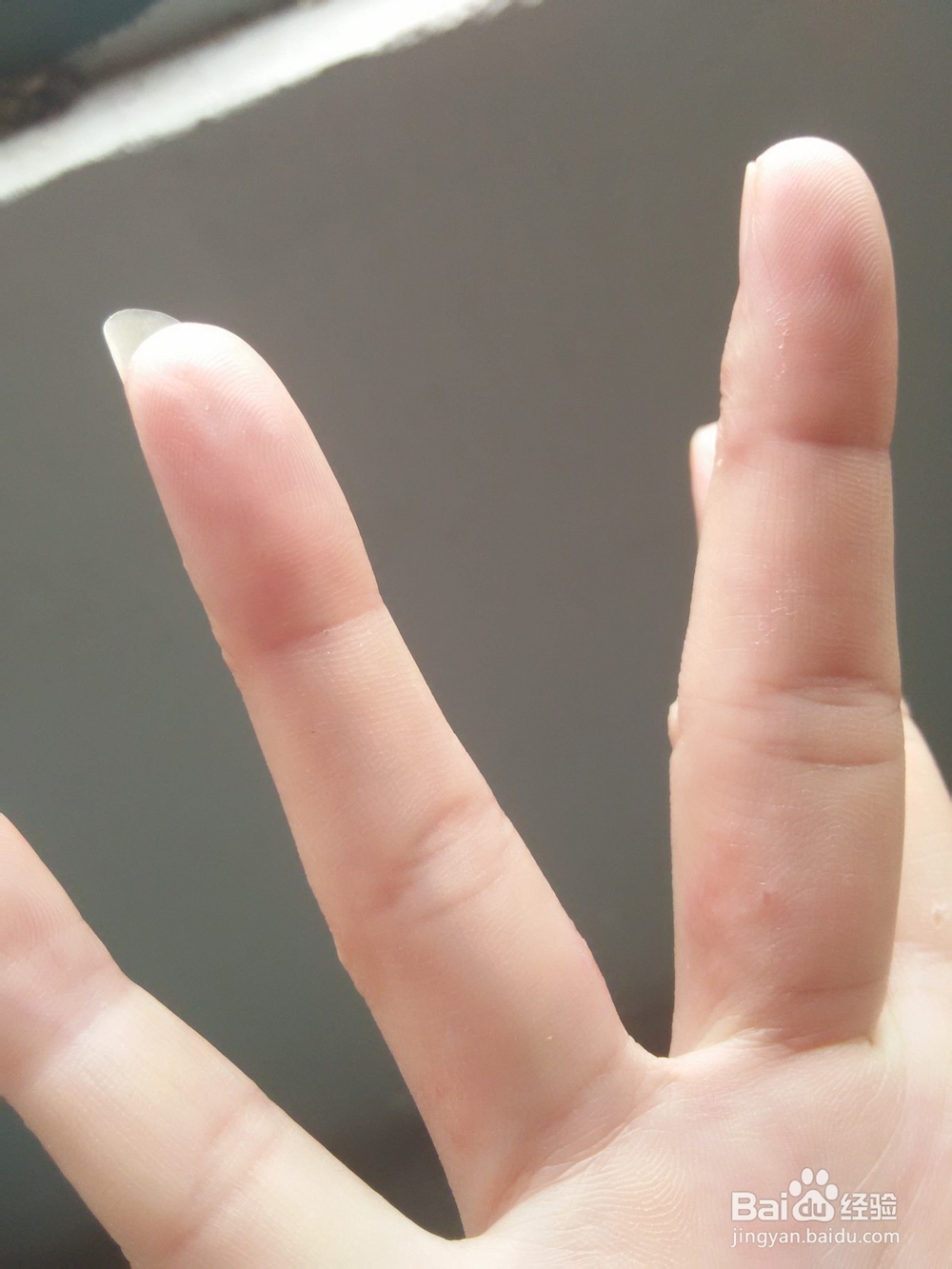 分享手上长水泡如何治愈的方法