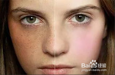 脸上雀斑怎么消除