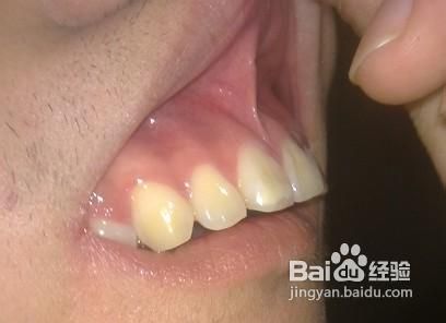 龅牙的价格是多少?