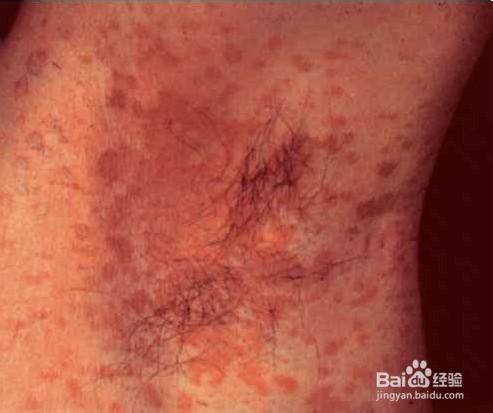 夏季如何预防花斑癣