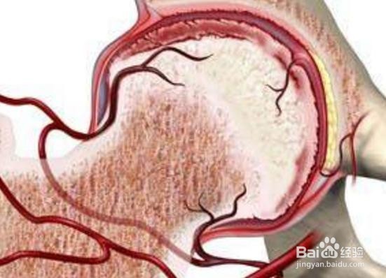 股骨头坏死怎么止痛