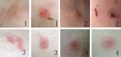 鼻子下面起泡速好方法