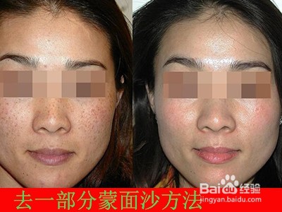 什么东西能去干净脸上蒙面纱/如何治疗蒙面沙好