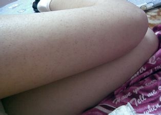 鸡皮肤怎么治？夏季鸡皮肤如何护理