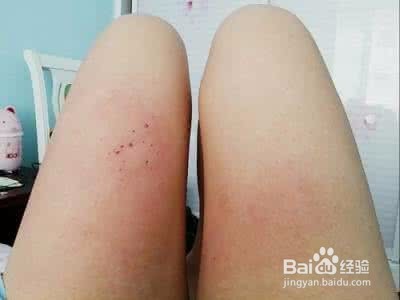 开水烫手了,如何处理?
