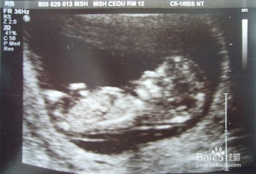 唐筛与糖筛的区别