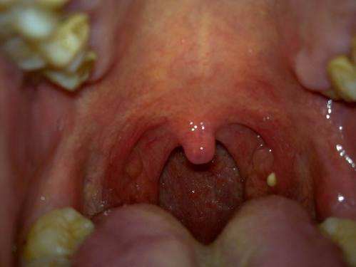 判别儿童患有扁桃体肥大增生的办法