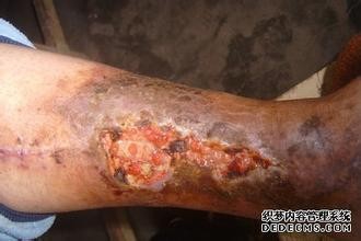 老烂腿患者该如何护理