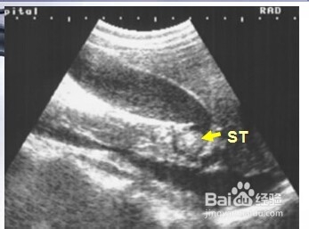 胆道系统几种常见疾病的影像图片。
