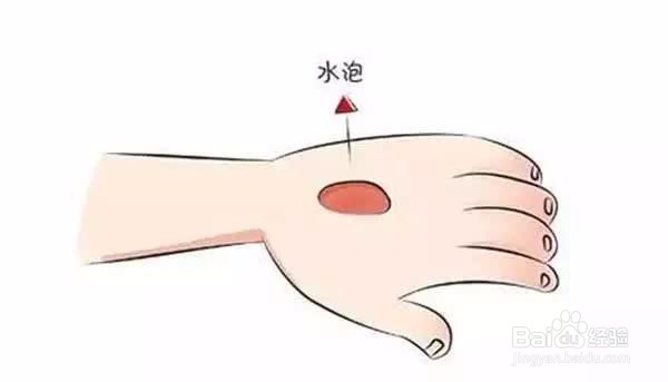 烫伤后千万不要用牙膏!教你如何正确应对烫伤