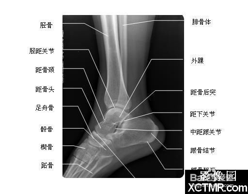 脚骨头x光正常图片图片