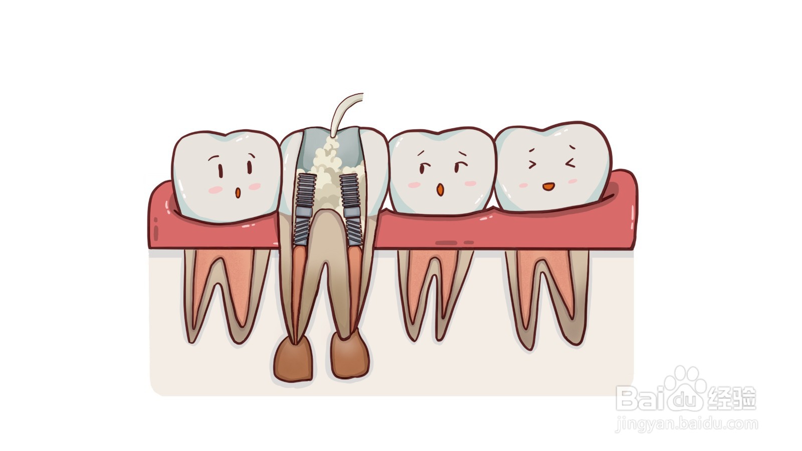 什么是根管治疗？有什么危害？