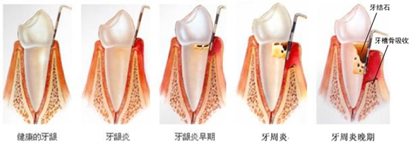 牙龈出血，并不是补充维生素就可以的