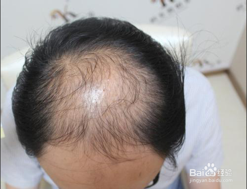 鬓角种植前怎么做不会留下疤痕