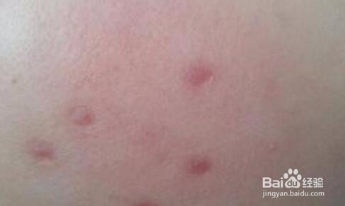 点痣有哪些危害